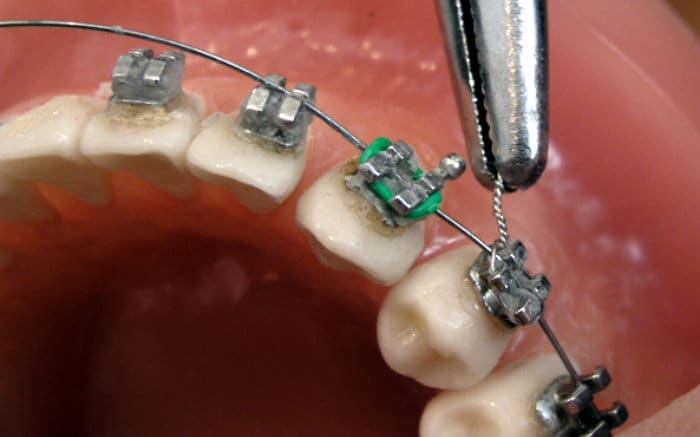 Imagem de dente com aparelho para ilustrar texto sobre aparelho ortodôntico