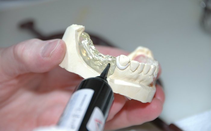 imagem de molde dentário para ilustrar texto sobre a diferença entre prótese e implante