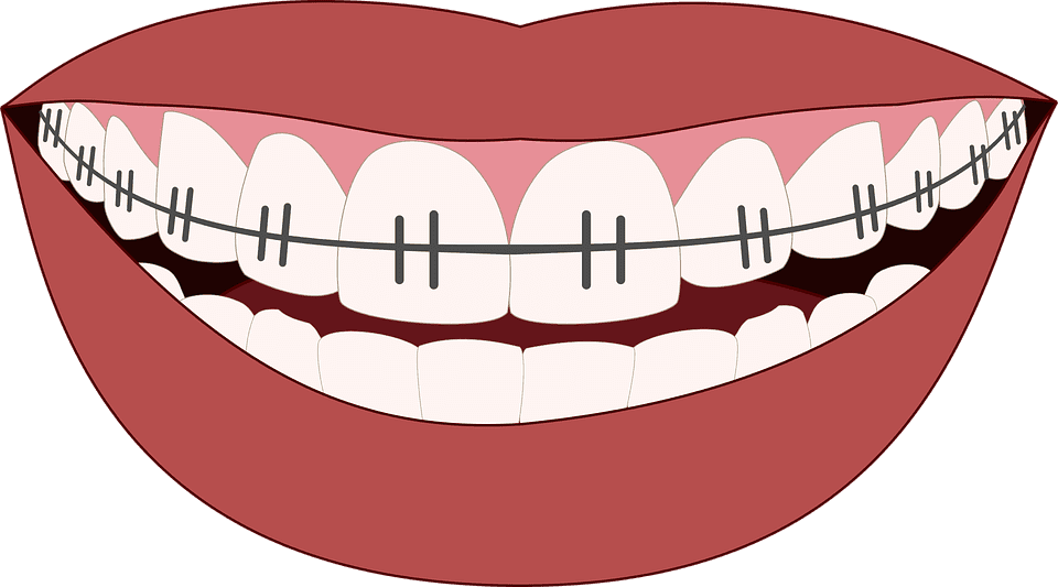 Desenho de boca com dentes com aparelho para ilustrar texto sobre cuidados com os dentes com aparelho.