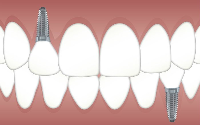 Desenho de dentes implantados para ilustrar texto sobre implantodontia